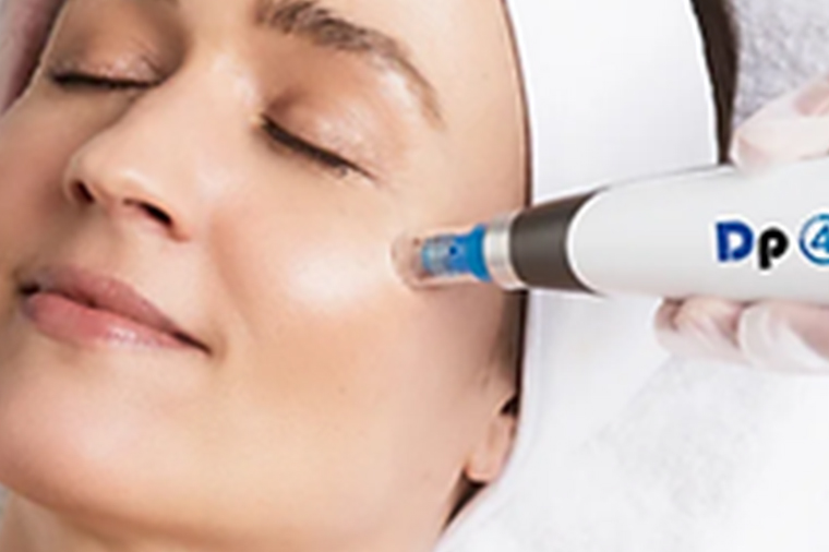 DP4 Microneedling Services in Edmonton, AB
